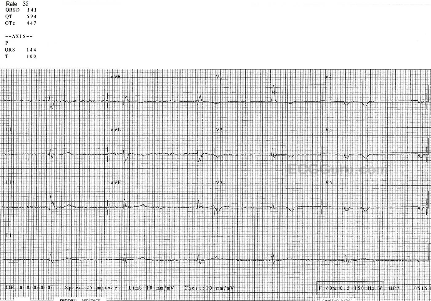 Marked Bradycardia With Bifascicular Block ECG Guru Instructor Resources